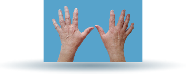 Zmiany zwyrodnieniowe stawów