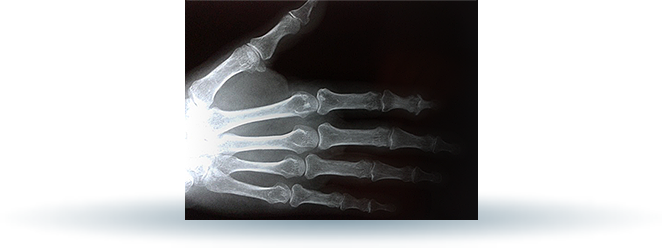RTG ręki. Zmiany zwyrodnieniowe stawów ręki