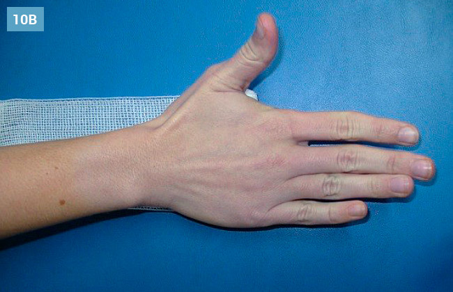 Ćwiczenie rozwijania i zwijania bandaża