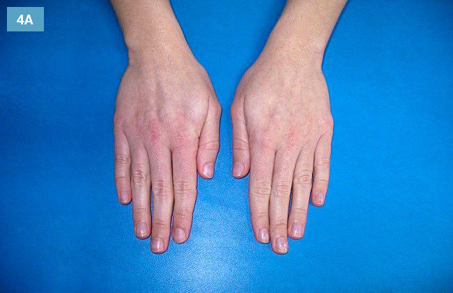 Ćwiczenie odwodzenie i przywodzenie palców