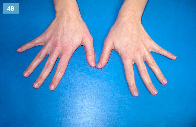 Ćwiczenie odwodzenie i przywodzenie palców